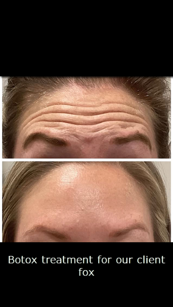 antalya botox fox botox