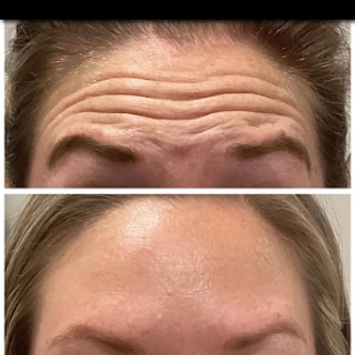 antalya botox fox botox
