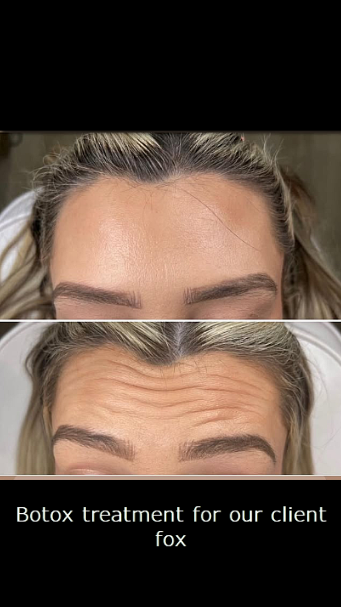 antalya botox fox kuaför kundu turızm bolgesi