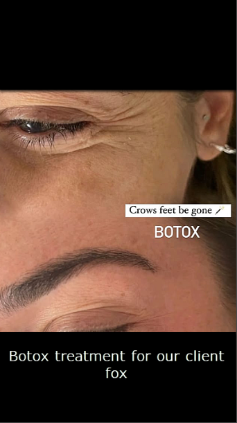 botox antalya clinic fox coiffeurbotox antalya clinic fox coiffeur