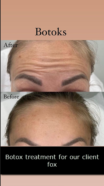 botox antalya fox kuaför botoxbotox antalya fox kuaför botox