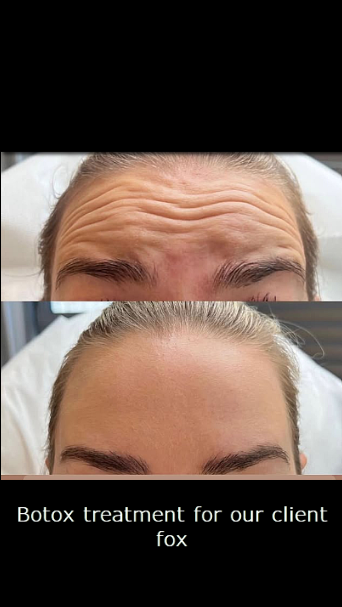 botox antalya uygulama fox kuaför