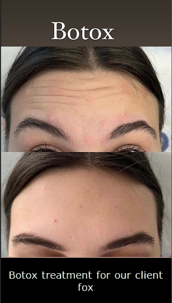 kundu fox coiffeur botox antalya